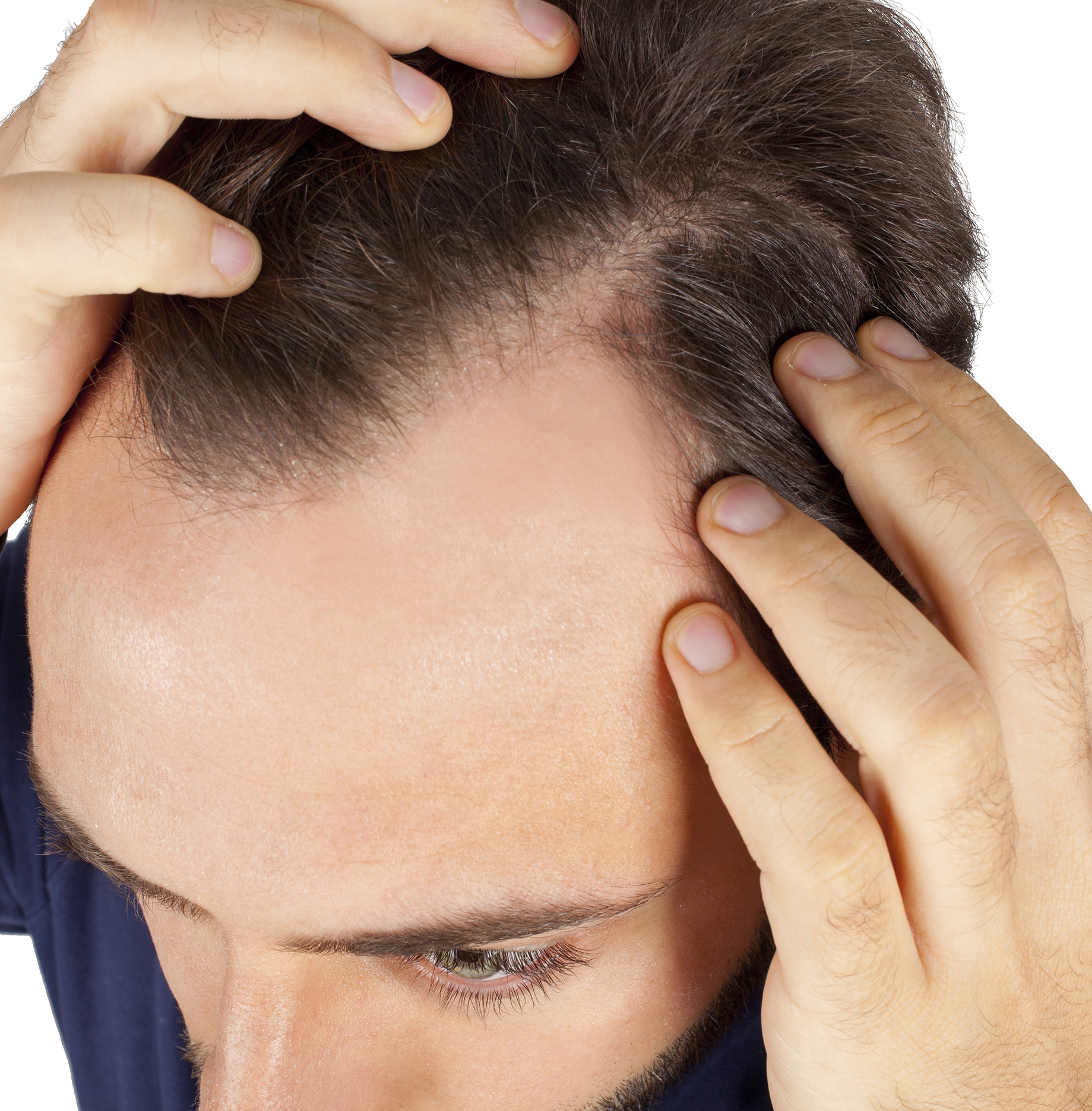 Men's Hair Loss: What You Need to Know