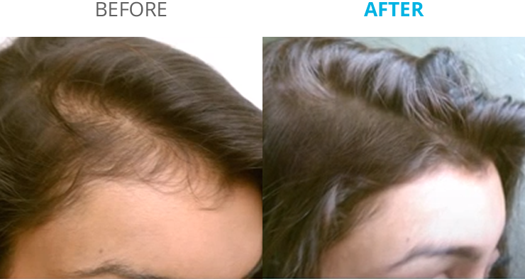 New Remedy for Hair Growth Toppik Theradome