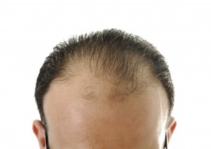 Hair loss man, baldness