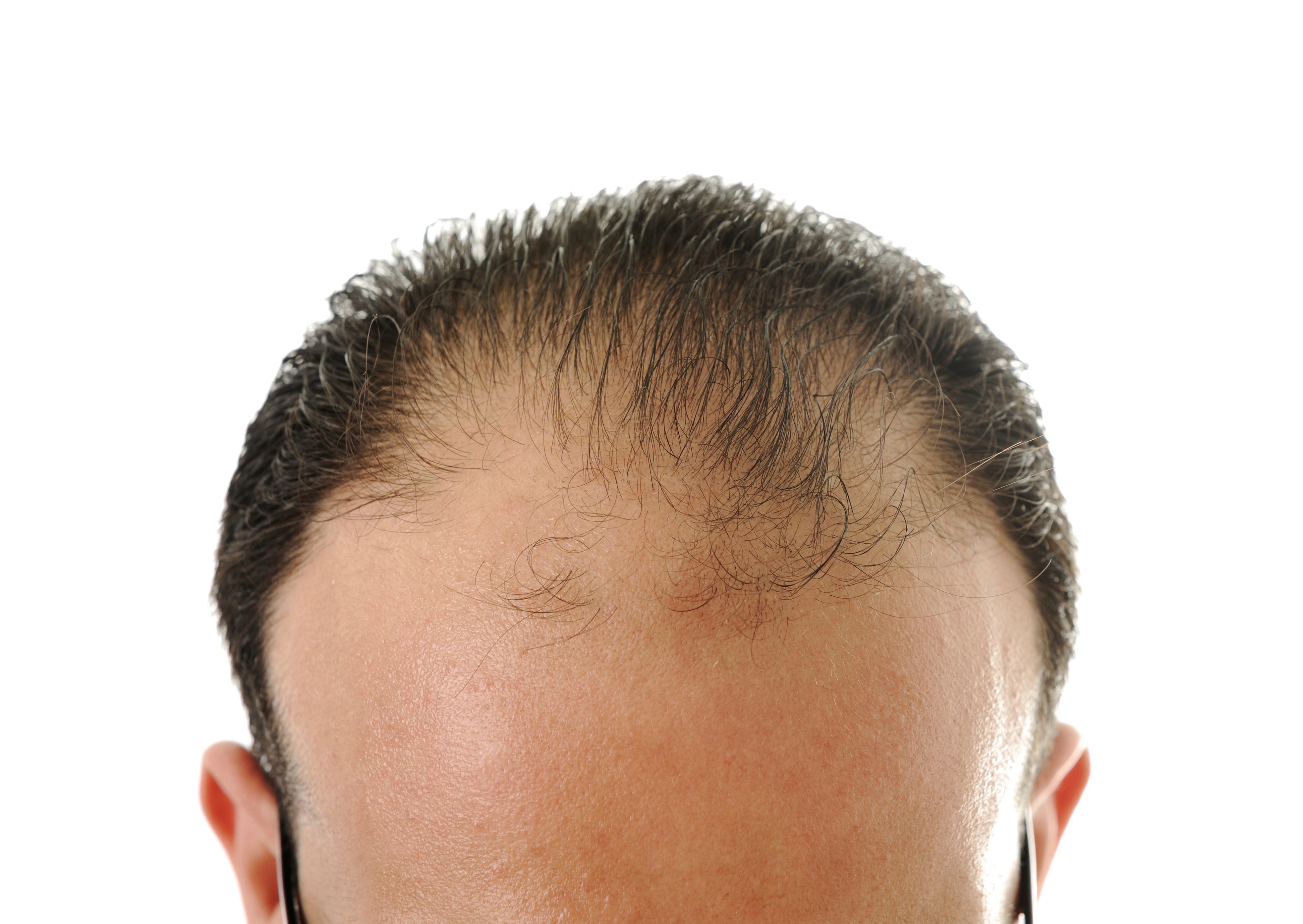 Man losing hair, baldness