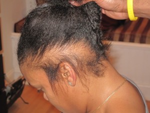 african-american-hairloss-weave-damage