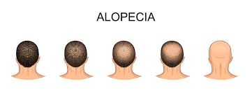 Hairstyles for Women with Frontal Fibrosing Alopecia  CSS Philadelphia 