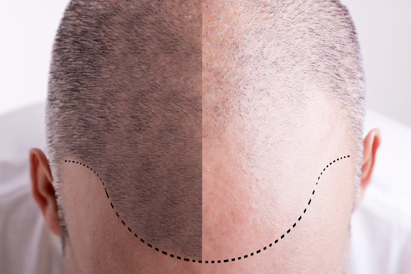 Top view of a men's head with a receding hair line - Before and After
