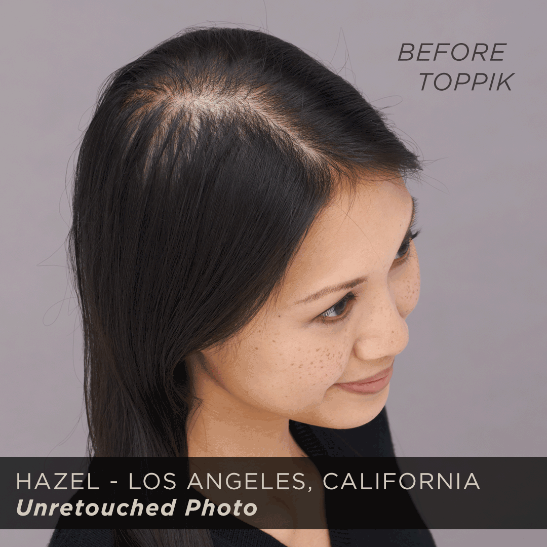 How Toppik Works on Hazel's Genetic Hair Loss - Toppik Blog