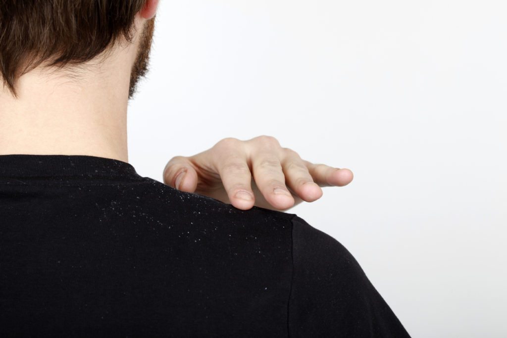 Man brushing dandruff shoulder black shirt solving scalp conditions toppik hair blog