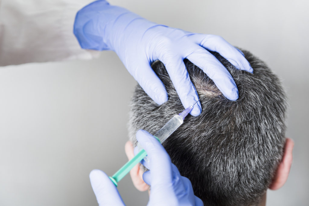 Doctor injection scalp man gray hair medical treatment toppik hair blog